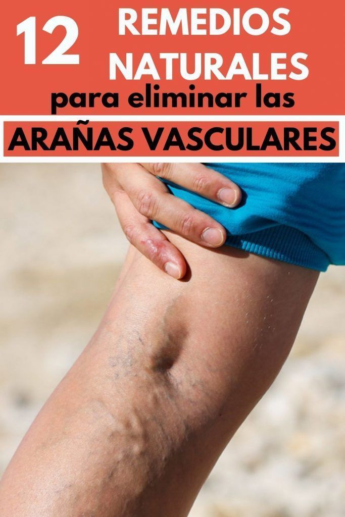Correr & Fitness | Deporte y Actividad Física 2 ARAÑAS VASCULARES